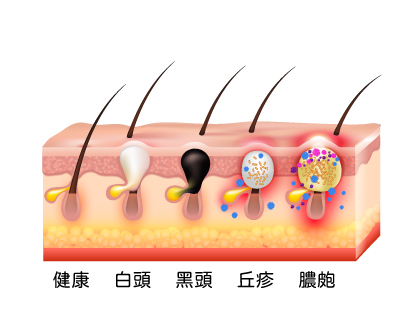 痘痘形成原因 里約風診所 內包粉刺 痘痘介紹 除理方式 醫師 台南 皮膚